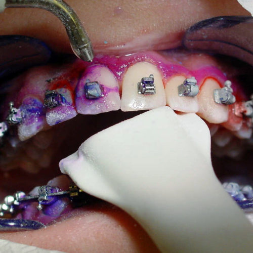 Die professionelle Zahnreinigung gibt es auch für Träger von festen Zahnspangen.