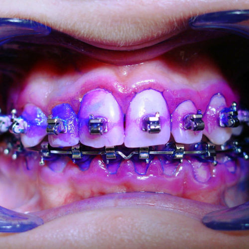 Die professionelle Zahnreinigung bei fester Zahnspange entfernt auch Schmutz an schwierigen Stellen.