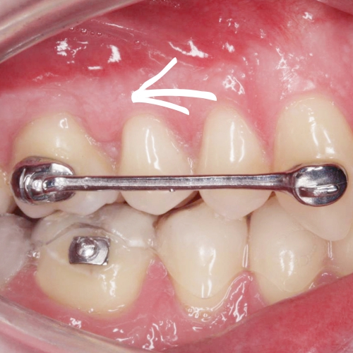 Zahnreihen können mit bestimmten Zahnspangen komplett verschoben werden.
