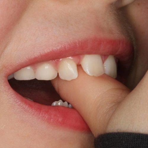 Daumenlutschen ist schädlich für die Zähne.