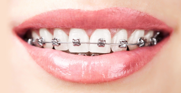 Schnelle Zahnkorrekturen mit Speedbrackets bei fester Zahnspange.