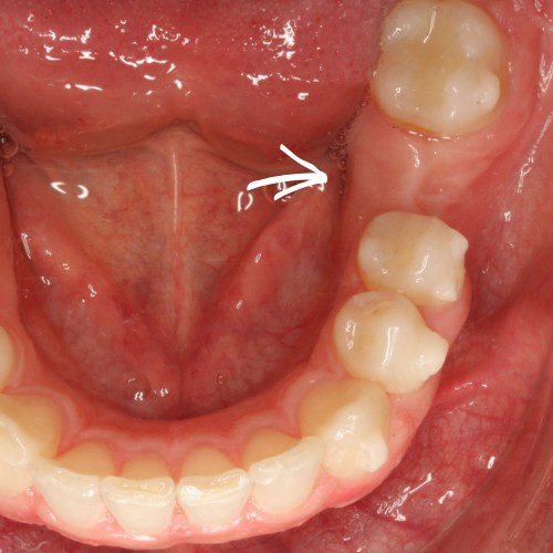 Kieferorthopädie als Vorbereitung für den Zahnersatz.