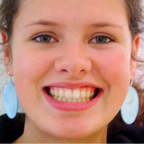 Zahnspange Kinder: Vorher Nachher