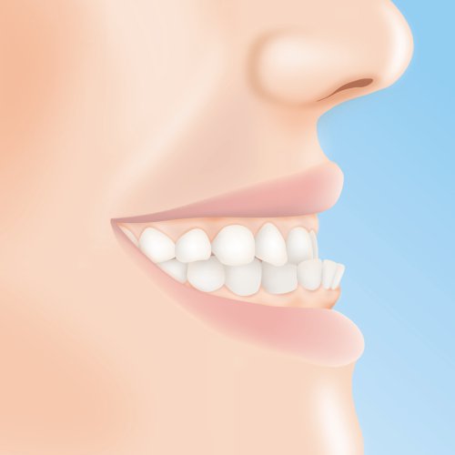 Zähne kleben lockere Implantat oder