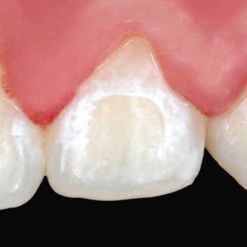 Entkalkungen können durch einen unvorhandenen Schutz bei fester Zahnspange entstehen.