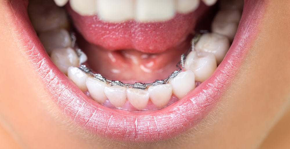 Linguale Zahnspange im Mund
